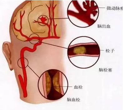 腦梗死