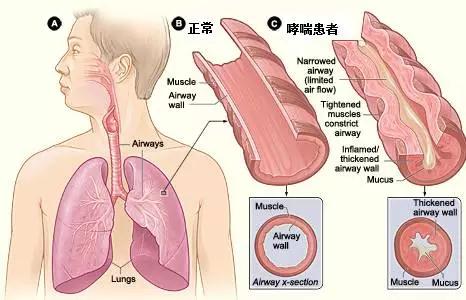 支氣管哮喘